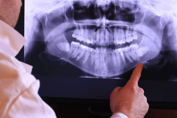 Best Knocked-Out Tooth (Avulsed Tooth) Treatment in Meade, KS
